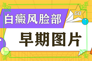 白颠疯可以治疗好吗,治疗时应该注意什么(能尽快治疗好吗)