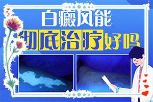 屁股长白班怎么办(如何比较好的治疗)-皮肤白的治疗办法