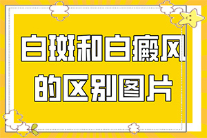 脸上白斑怎么回事[啥原因呢]白癜风需要哪种检查