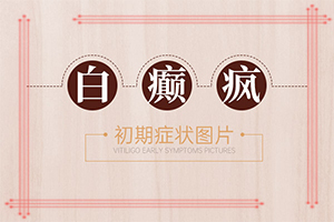 皮肤过敏后出现白斑白癜风都是做哪些检查?