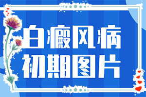 白颠病怎么治(治疗有哪些要注意的)-白颠疯病可以吗